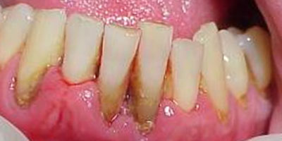 minimal masse Påstået Parodontose og tandkødsbetændelse - Tandlægerne Torvegade